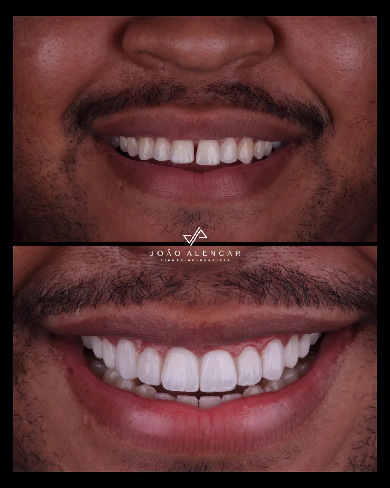 Procedimento de Facetas em Resina